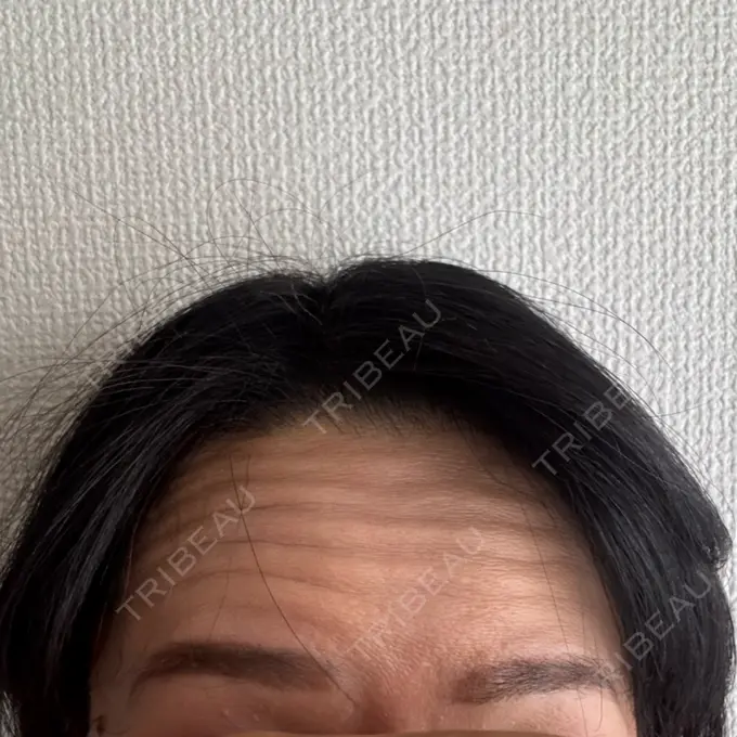 ボトックス（額） LIBER CLINIC BEFORE メイン用