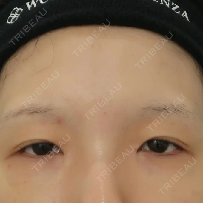 二重切開 / 眼瞼下垂（切開） / 目尻切開 / 上まぶたたるみ取り / 眼瞼下垂（非切開） / その他（目元） WOM CLINIC GINZA （ワム クリニック ギンザ） BEFORE メイン用