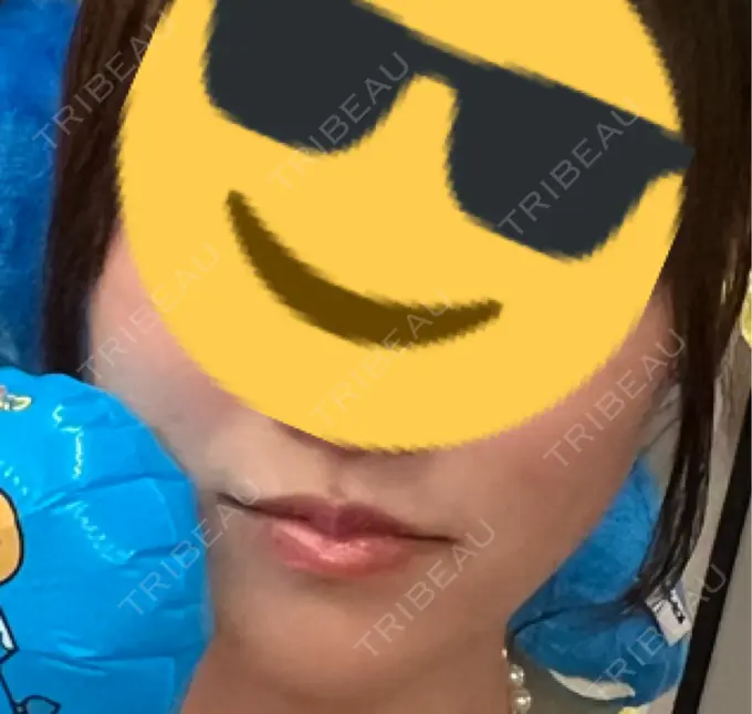 光治療（フォトフェイシャルなど） Sea Sail Beauty Clinic BEFORE メイン用