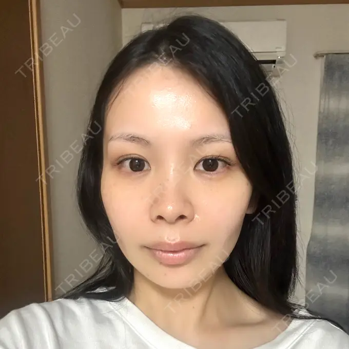 脂肪吸引（顔） 小倉美容外科ネビュラクリニック BEFORE メイン用