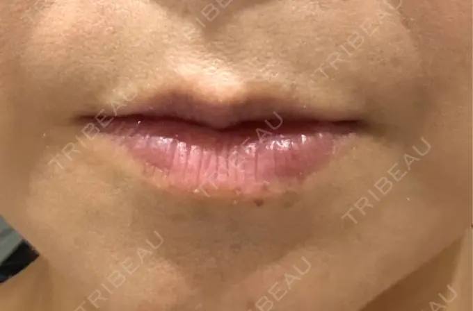 肌ヒアルロン酸注入（たるみ・シワ改善） Grias clinic （ジリアスクリニック） BEFORE メイン用