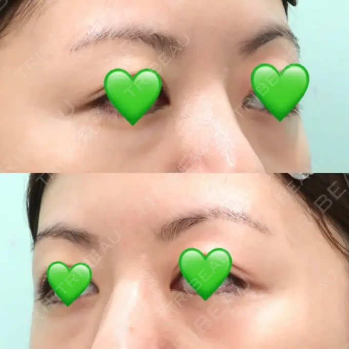 下まぶたの脂肪取り / 脂肪注入（目の下） WOM CLINIC GINZA （ワム クリニック ギンザ） BEFORE メイン用