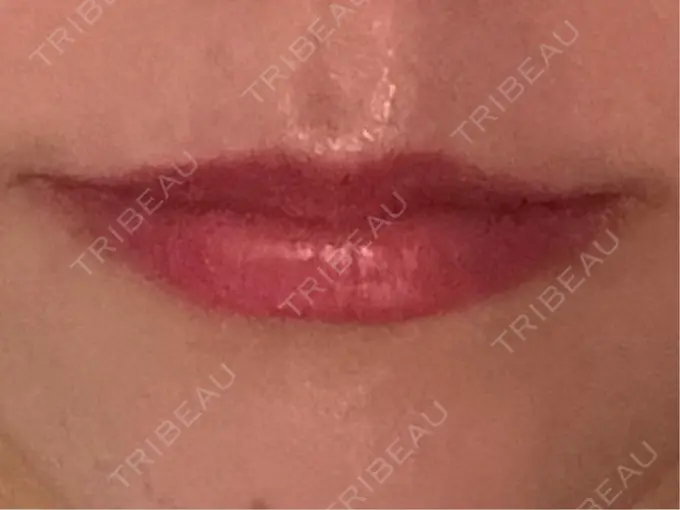 ヒアルロン酸注入（涙袋） / ヒアルロン酸注入（唇） / ボトックス（口角） 日本ウェルネス再生クリニック BEFORE メイン用