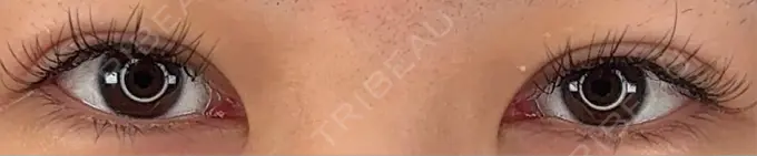 二重埋没 / 上まぶたの脂肪取り / ヒアルロン酸注入（涙袋） アリエル美容クリニック 横浜院 BEFORE メイン用