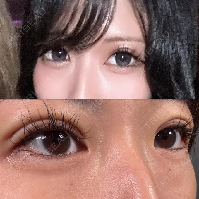 二重埋没 新宿美容外科ネビュラクリニック BEFORE メイン用