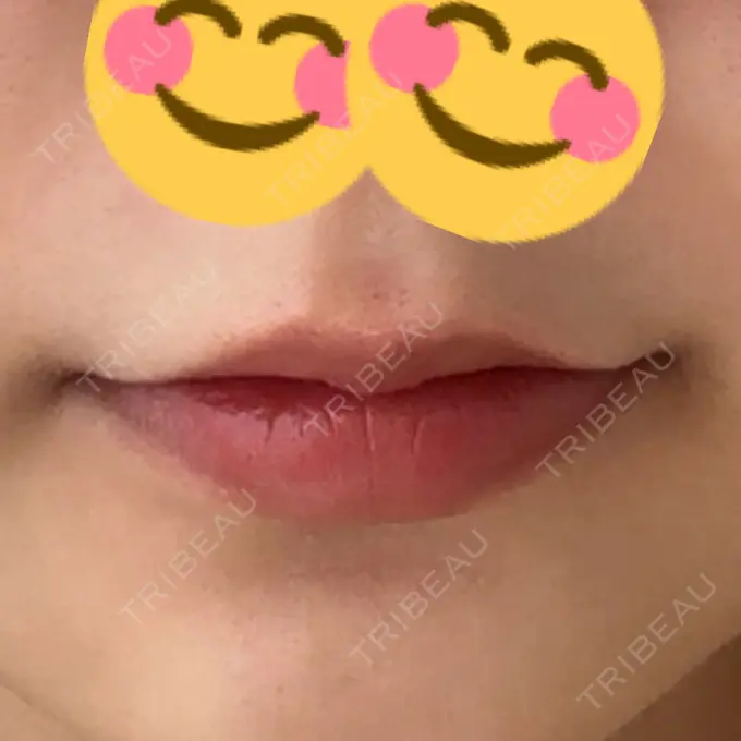 ヒアルロン酸注入（唇） アリエル美容クリニック 横浜院 BEFORE メイン用