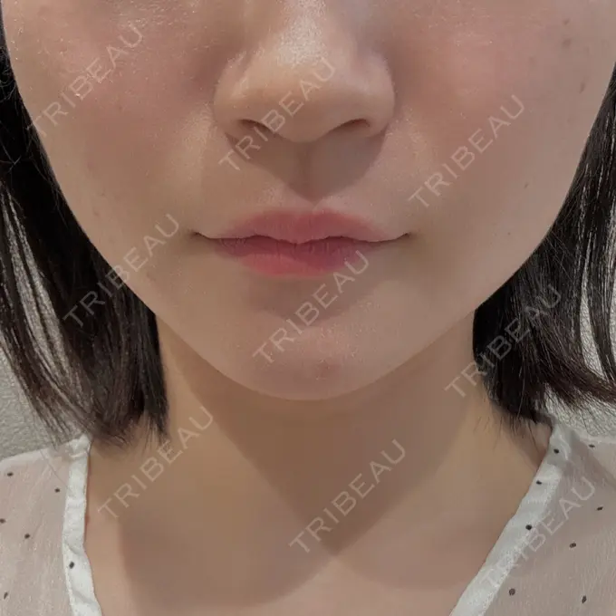 糸リフト / 脂肪吸引（顔） / 脂肪吸引注射（顔） ziz CLINIC BEFORE メイン用