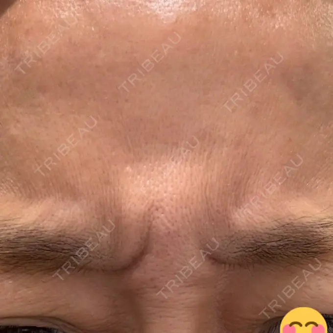 ボトックス（あご） / ボトックス（眉間） / ボトックス（額） / ボトックス（バニーライン） TCB東京中央美容外科 町田院 BEFORE メイン用