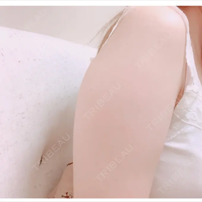 脂肪吸引（二の腕） 湘南メディカル記念病院（両国） BEFORE メイン用