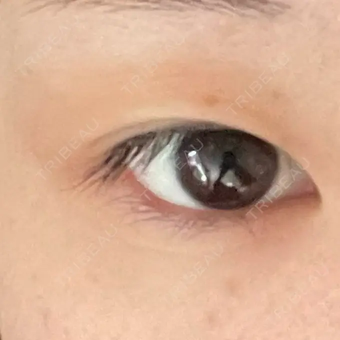 二重埋没 / ヒアルロン酸注入（涙袋） / ボトックス（エラ・小顔） / ヒアルロン酸注入（唇） / ボトックス（眉間） ネビュラクリニック 東京錦糸町院 BEFORE メイン用