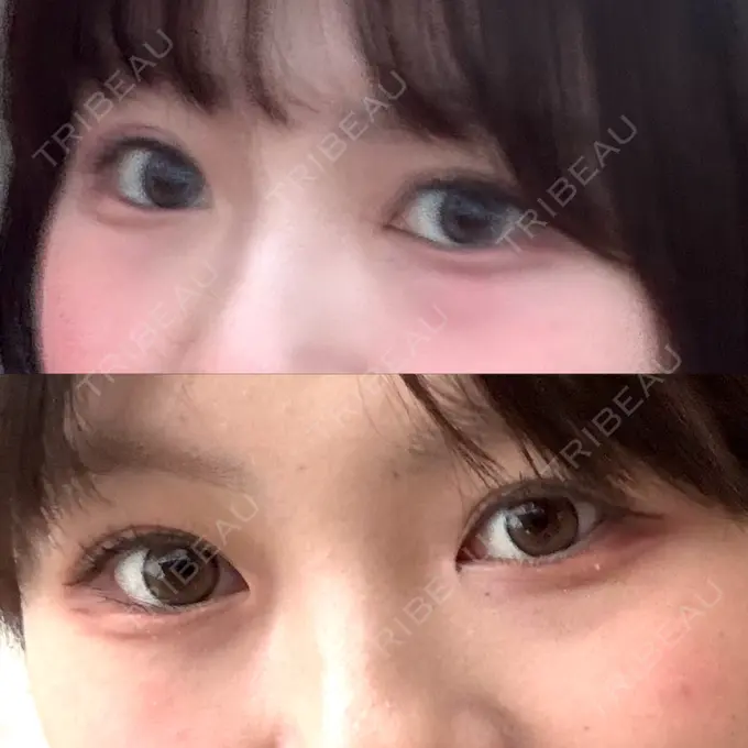 クマ治療 R Beauty CLINIC 銀座院 BEFORE メイン用