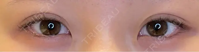 目尻切開 / タレ目形成・グラマラスライン（埋没） LOUIS CLINIC 二子玉川院【ルイクリニック】 BEFORE メイン用