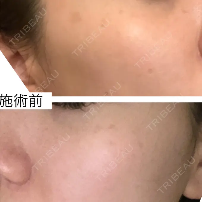 ピコスポット 博多もへじのクリニック BEFORE メイン用