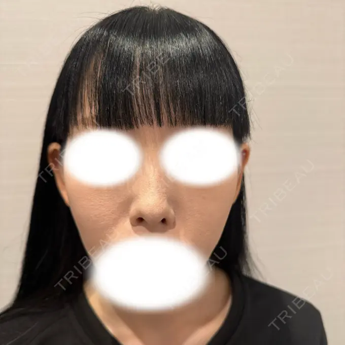 鼻尖形成（切開） / 鼻中隔延長（切開） / 軟骨移植 R Beauty CLINIC 名古屋院 BEFORE メイン用