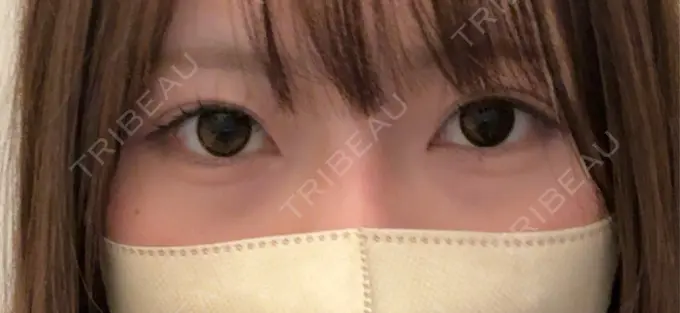 クマ治療 / ヒアルロン酸注入（目の下） eクリニック 名古屋院 BEFORE メイン用