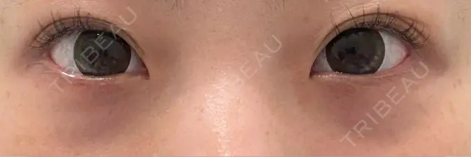 クマ治療 / 脂肪注入（目の下） R Beauty CLINIC 銀座院 BEFORE メイン用