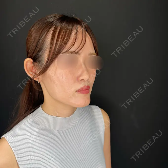 ヒアルロン酸注入（鼻） / ヒアルロン酸注入（鼻翼基部） HAAB×DREAM BEAUTY CLINIC 大阪梅田院 BEFORE メイン用