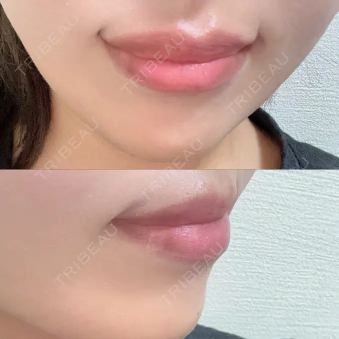 ボトックス（あご） / ボトックス（口角） 表参道ウィズ・クリニック BEFORE メイン用