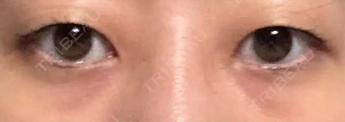 クマ治療 / 下まぶたたるみ取り / 下まぶたの脂肪取り / その他（目元） ROOTS Clinic BEFORE メイン用