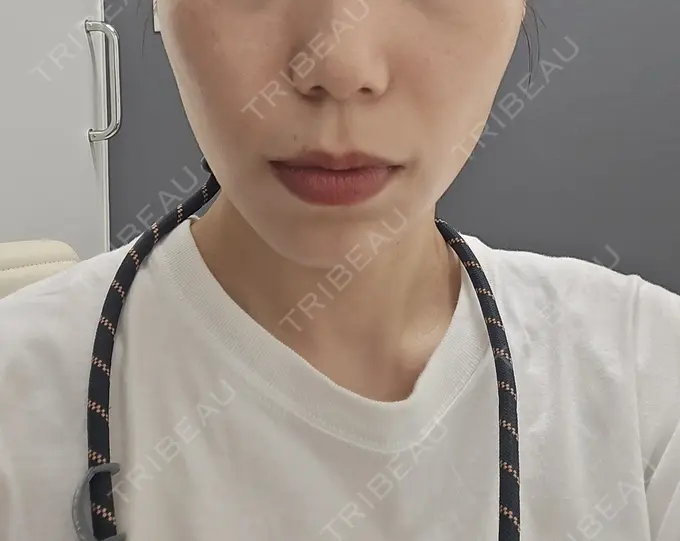 ハイフ（顔） 東京美容外科 福岡院 BEFORE メイン用