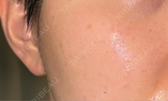 その他（肌） / ピーリング（ハリ・ツヤ） / ルメッカ BITO BEAUTY CLINIC BEFORE メイン用