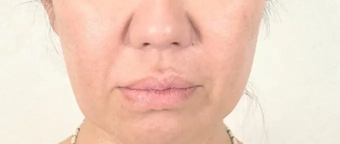 糸リフト アリエル美容クリニック 横浜院 BEFORE メイン用