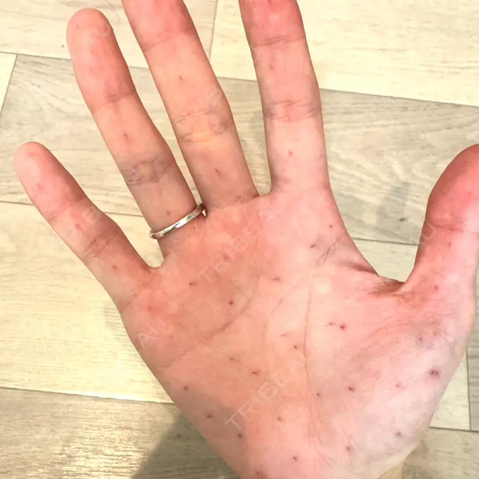 多汗症治療（ボトックス） ゆきスキンクリニック 東池袋 BEFORE メイン用