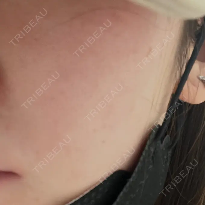 イオン導入 / ピーリング（ハリ・ツヤ） / ルメッカ ルラ美容クリニック 仙台院 / ルラスキンクリニック 仙台院 BEFORE メイン用