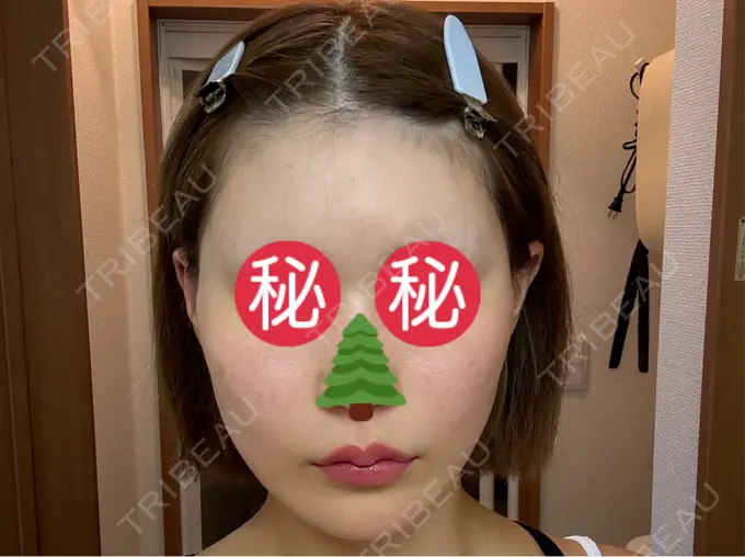 切開リフト GRACY TOKYO CLINIC【グレイシートウキョウクリニック】 BEFORE メイン用