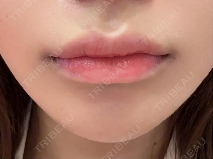 アートメイク（唇） 筋肉・美容クリニック BEFORE メイン用