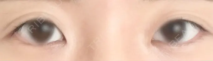 目頭切開 PRISM Beauty Clinic 町田院 BEFORE メイン用