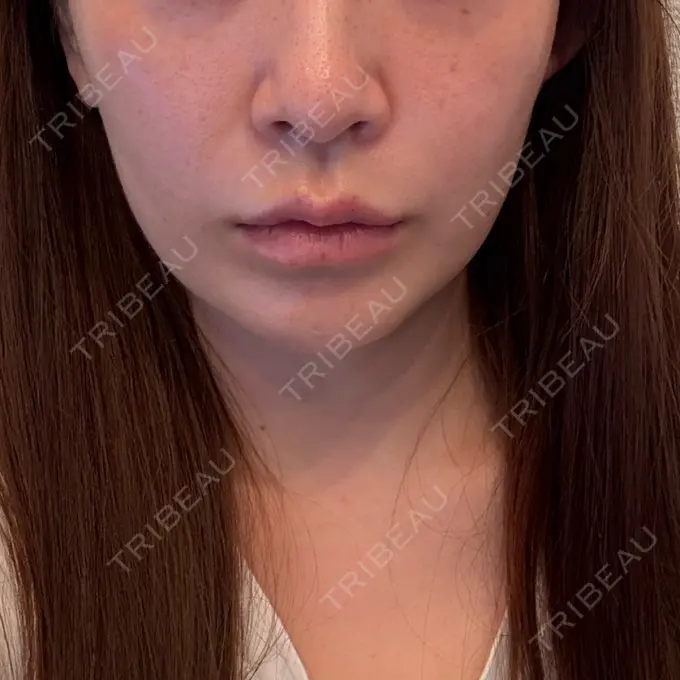 肌ヒアルロン酸注入（たるみ・シワ改善） / ヒアルロン酸注入（唇） 東京シルククリニック 東京神田院 BEFORE メイン用