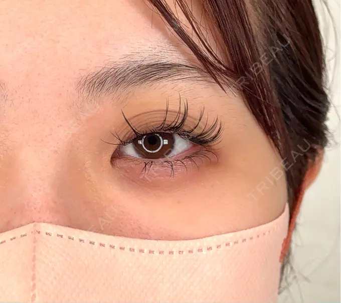 二重埋没 / バッカルファット除去 / ヒアルロン酸注入（涙袋） / ボトックス（エラ・小顔） アリエル美容クリニック 横浜院 BEFORE メイン用