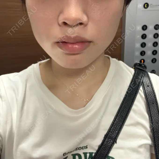 ボトックス（エラ・小顔） 新未来クリニック BEFORE メイン用