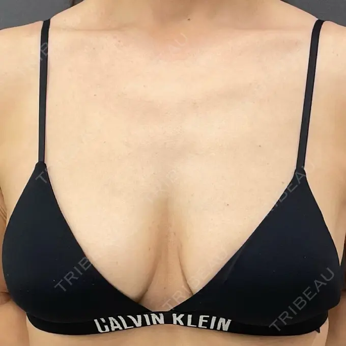 豊胸（シリコンバッグ） / その他（胸） ルーチェクリニック 銀座院 BEFORE メイン用