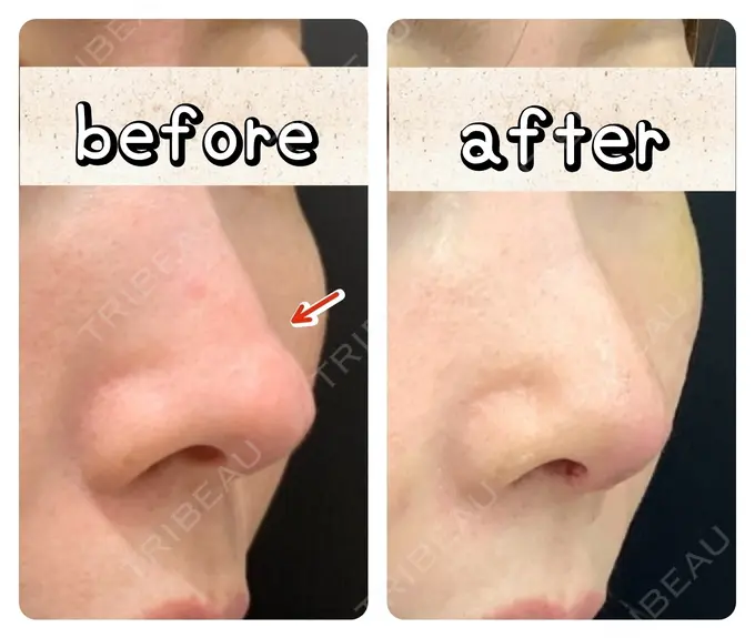 鼻尖形成（切開） / 鼻中隔延長（切開） / 目元修正 / 脂肪注入（輪郭） eクリニック 富山駅前院 BEFORE メイン用