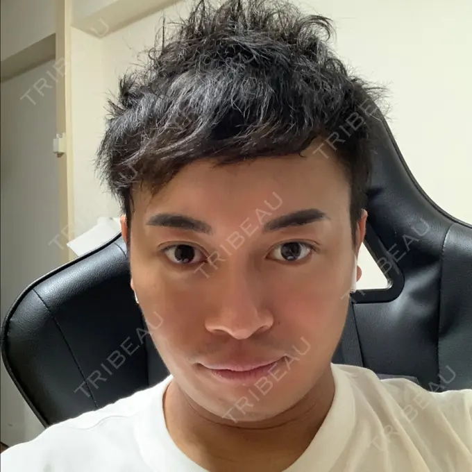 脂肪吸引（顔） THE CLINIC（ザ・クリニック） 東京院 BEFORE メイン用