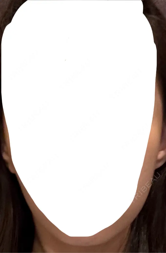 ヒアルロン酸溶解 EOL CLINIC【オルクリニック】 BEFORE メイン用