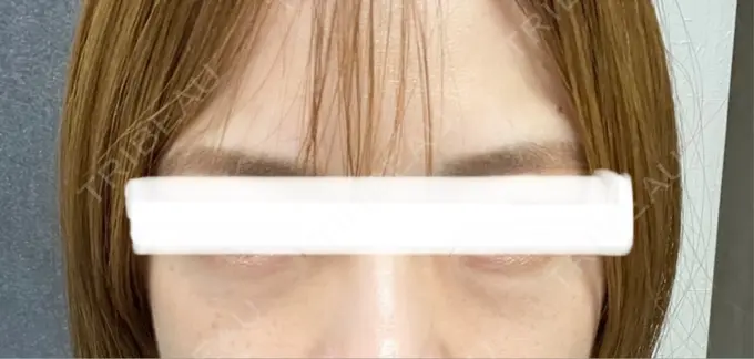 下まぶたの脂肪取り 川越TAクリニックアソシエ BEFORE メイン用