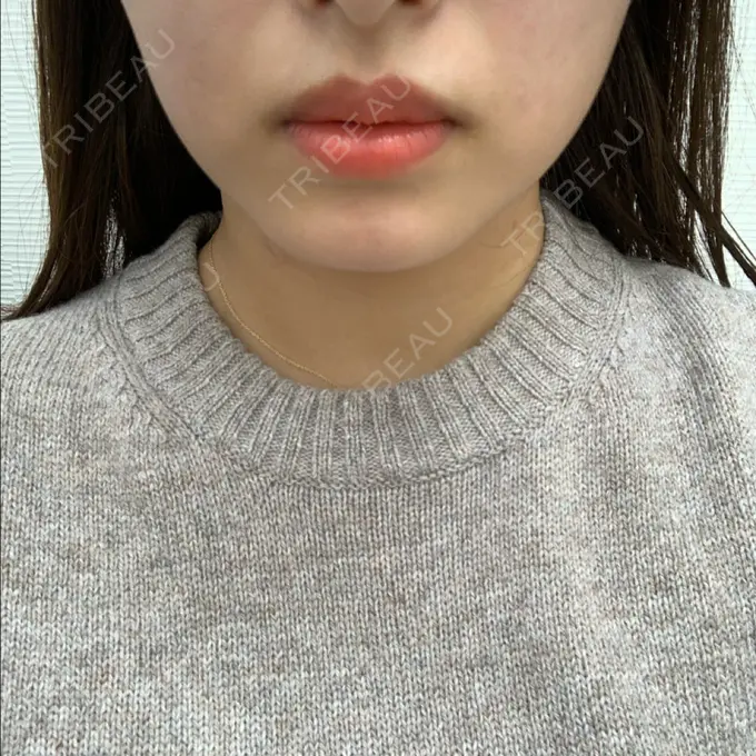 ボトックス（エラ・小顔） TCB東京中央美容外科 堺院 BEFORE メイン用