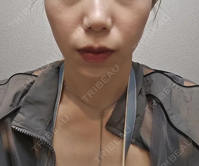 ボトックス（エラ・小顔） / ボトックス（肩） ヴァージンクリニック 福岡天神院 BEFORE メイン用