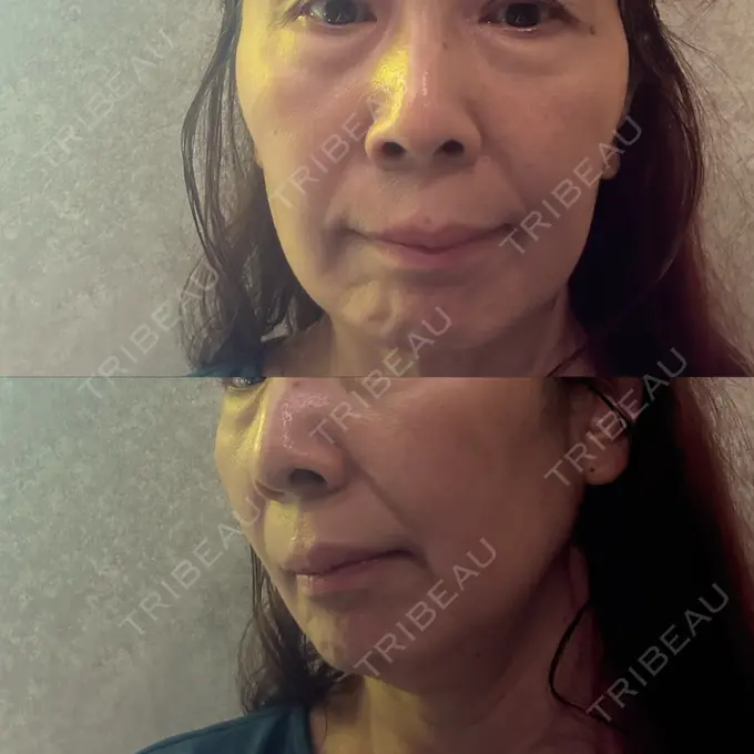 肌ヒアルロン酸注入（たるみ・シワ改善） / ヒアルロン酸注入（頬） / その他（口元） LIKI CLINIC KOBE BEFORE メイン用