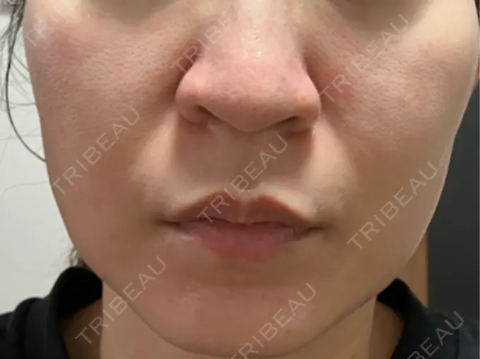 医療痩身（顔） 渋谷美容外科クリニック 横浜院 BEFORE メイン用