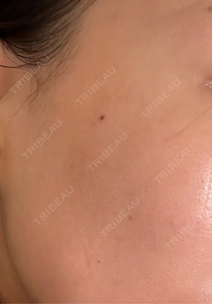 光治療（フォトフェイシャルなど） クレオビューティークリニック BEFORE メイン用