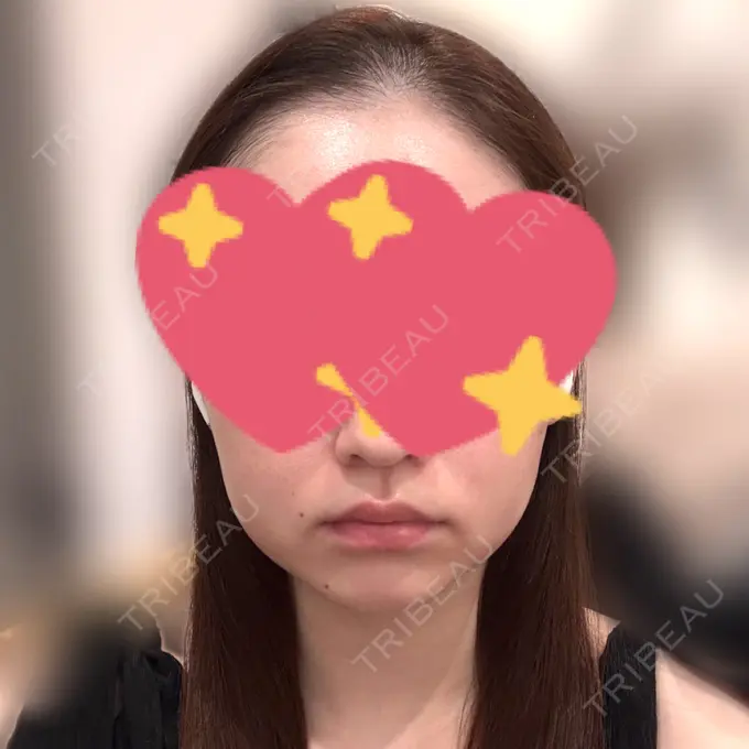 糸リフト / 脂肪吸引（顔） / ボトックス（あご） / ヒアルロン酸注入（あご） / ボトックス（エラ・小顔） / ヒアルロン酸注入（頬） / ヒアルロン酸注入（鼻翼基部） GRACIA clinic 【グラシアクリニック】 BEFORE メイン用