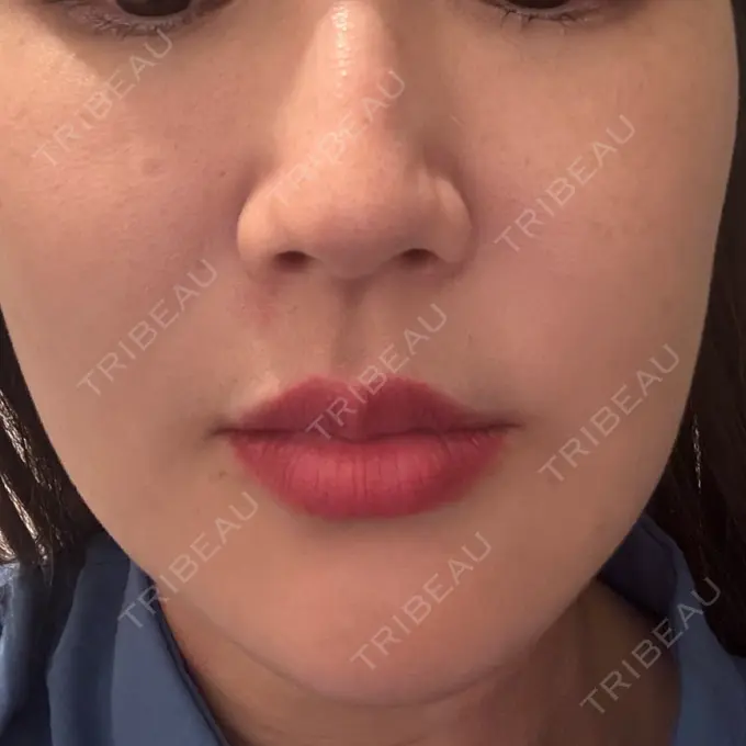 RF（高周波）たるみ治療 RIVER CLINIC（リバークリニック） BEFORE メイン用