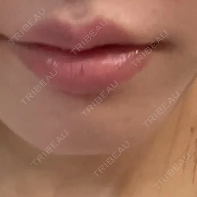 ボトックス（あご） ルラ美容クリニック 神戸院 BEFORE メイン用