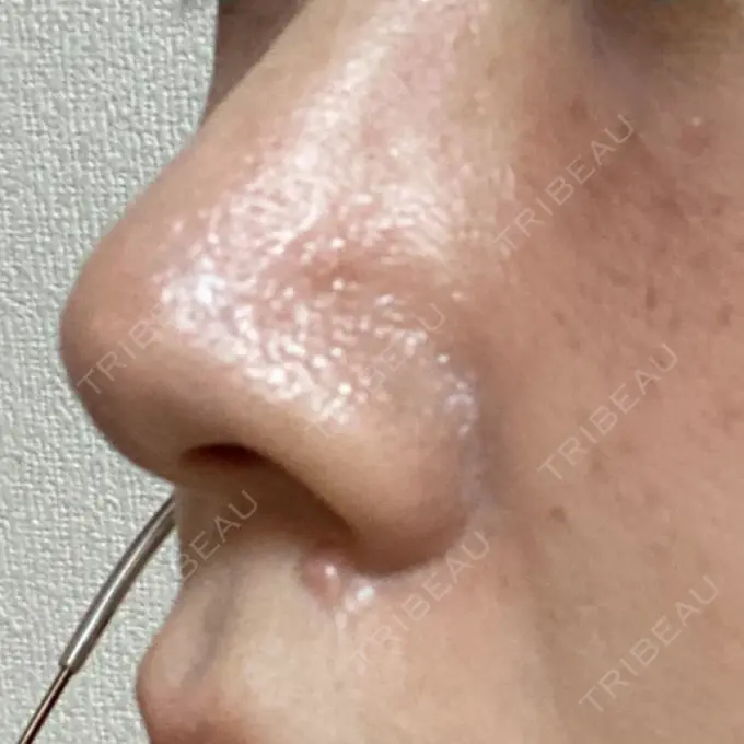 アグネス 日本美容・医療クリニック 六本木院 BEFORE メイン用