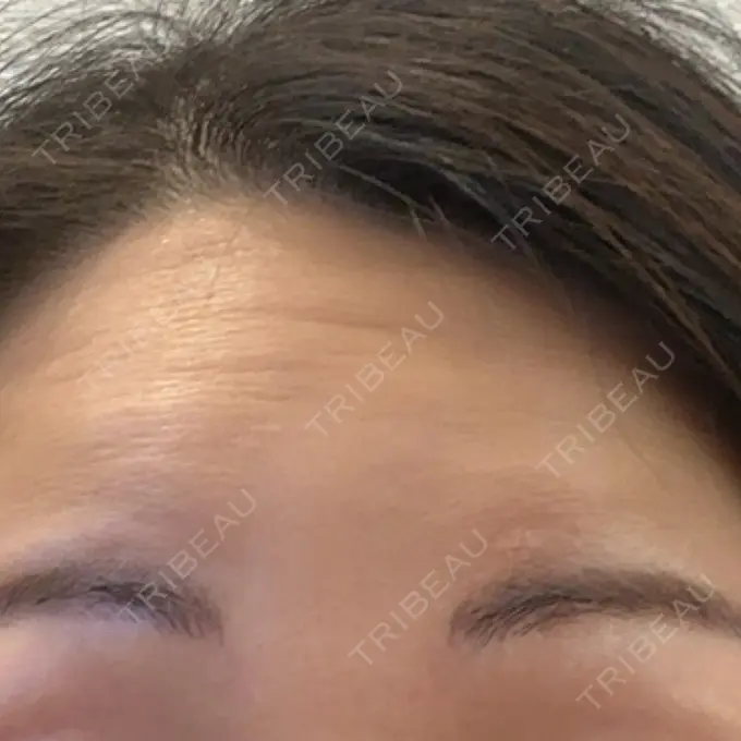 シワ取りボトックス 福岡TAクリニック BEFORE メイン用