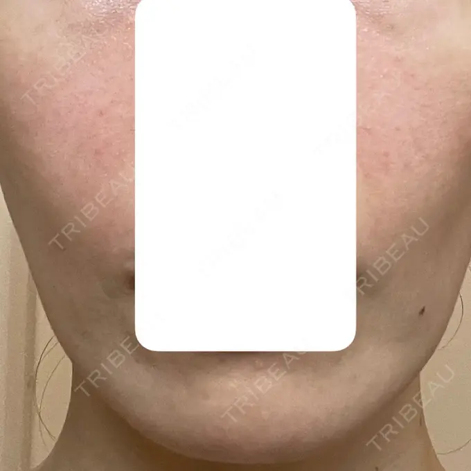 肌育注射（ジュベルックなど） 城本クリニック 長崎院 BEFORE メイン用